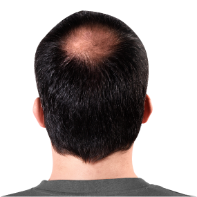 Hair-Loss Treatment
